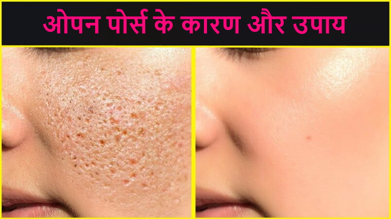 ओपन पोर्स के कारण और उपाय बताइए?