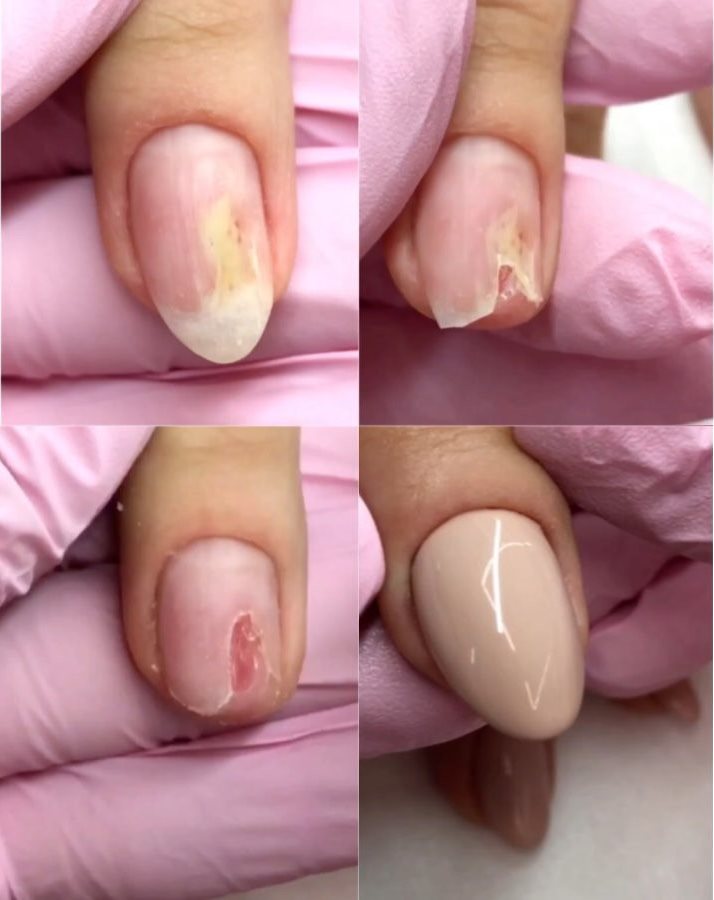 Broken Nails Transformation Pedicure Tutorials